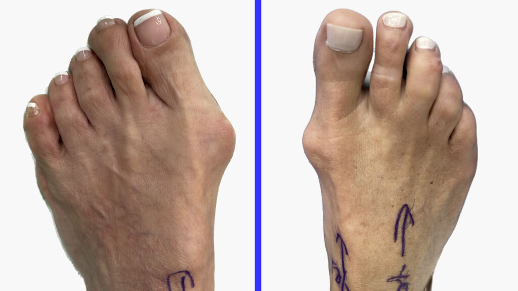 An image of two female patients with bunions taken at the Foot, Ankle & Leg Vein Center. A bunion, also known as hallux abducto valgus, is a common foot deformity. It is characterized by a bony bump or enlargement at the base of the big toe, which is caused by the deviation of the first metatarsal from its original position due to pronatory forces. As a result, the big toe starts to deviate towards the second toe, causing malalignment of the first MPJ and a visible bump on the inside of your foot.