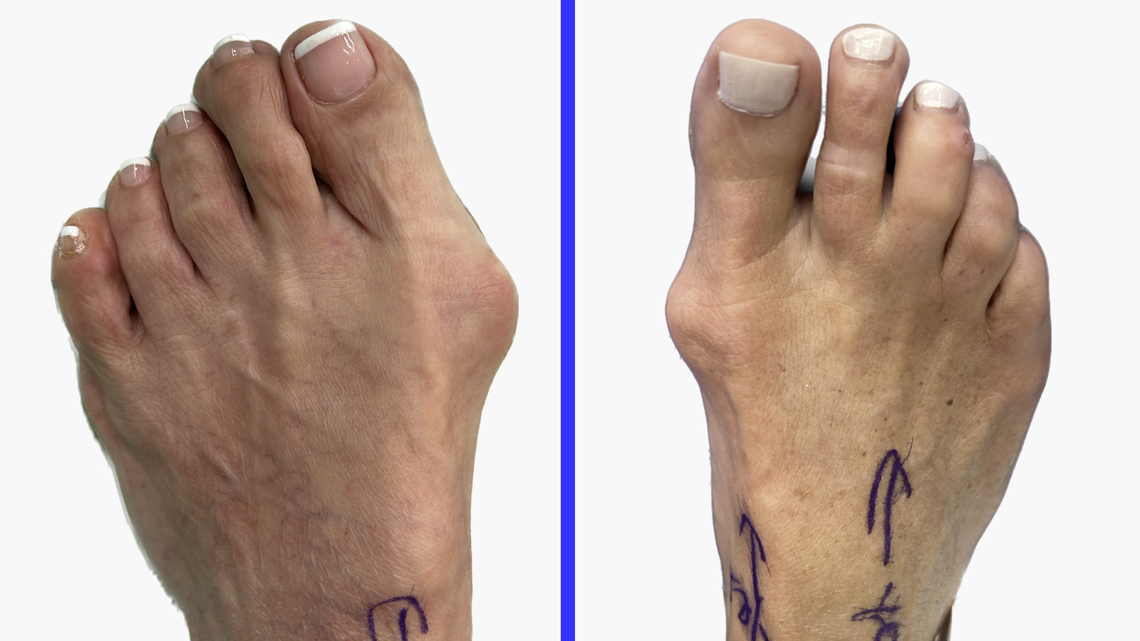 Lapiplasty: Learn All About This New, Breakthrough Bunion Surgery