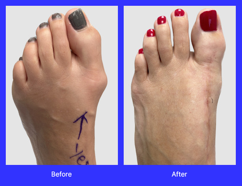 An image of Lapiplasty surgery performed by Dr. Jason Gold, DPM, FACFAS, a top-rated podiatrist with offices in Boca Raton, and Boynton Beach, FL.