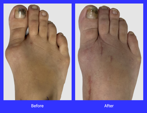 An image of Lapiplasty surgery performed by Dr. Jason Gold, DPM, FACFAS, a top-rated podiatrist with offices in Boca Raton, and Boynton Beach, FL.