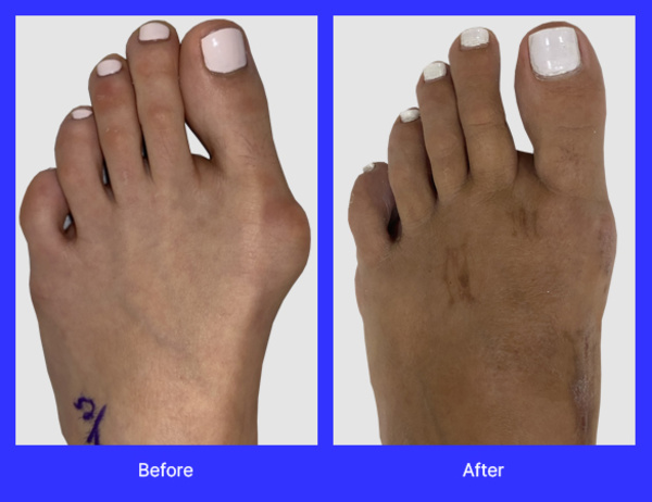 An image of Lapiplasty surgery performed by Dr. Jason Gold, DPM, FACFAS, a top-rated podiatrist with offices in Boca Raton, and Boynton Beach, FL.