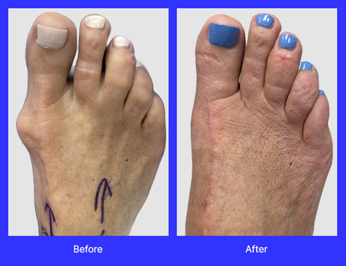 An image of Lapiplasty surgery performed by Dr. Jason Gold, DPM, FACFAS, a top-rated podiatrist with offices in Boca Raton, and Boynton Beach, FL.