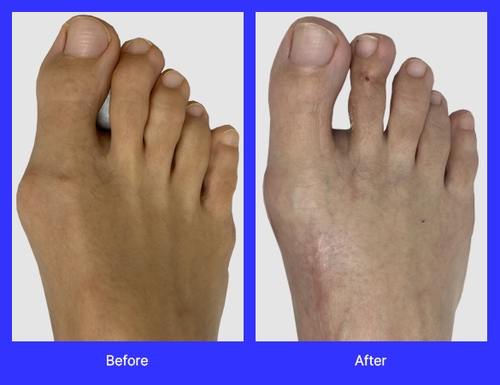 An image of Lapiplasty surgery performed by Dr. Jason Gold, DPM, FACFAS, a top-rated podiatrist with offices in Boca Raton, and Boynton Beach, FL.