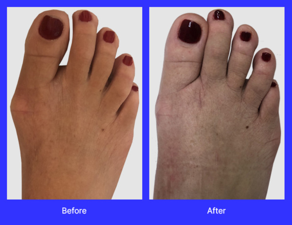 Lapiplasty surgery performed by Dr. Jason Gold, DPM, FACFAS, a top-rated podiatrist with offices in Boca Raton, and Boynton Beach, FL.