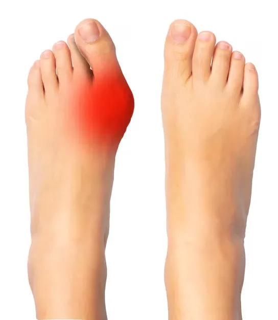 What Does a Bunion Look Like? Common Symptoms