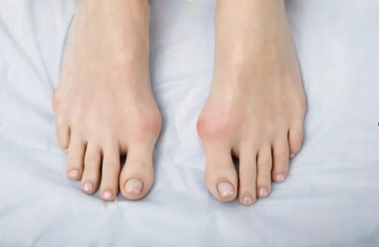 What Does a Bunion Look Like? Common Symptoms