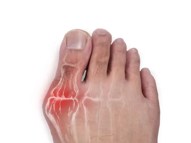 What Does a Bunion Look Like? Common Symptoms