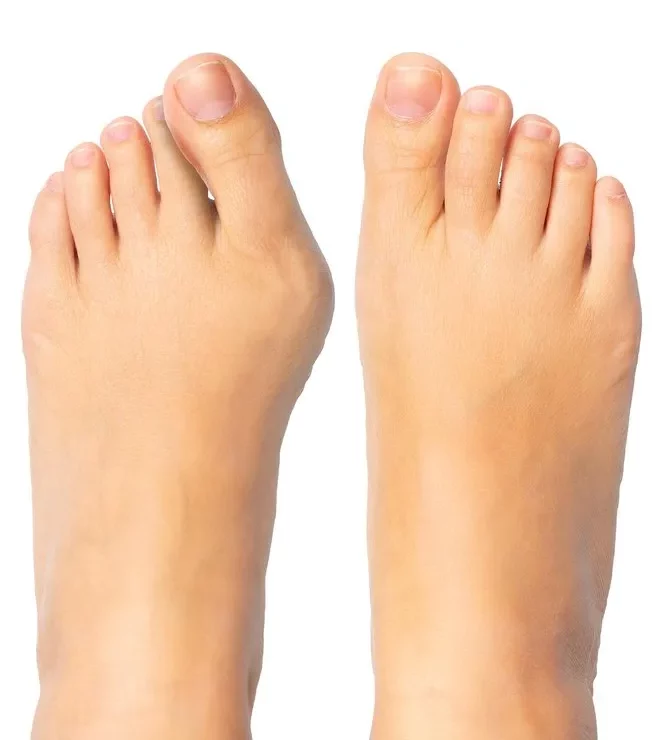 What Does a Bunion Look Like? Common Symptoms