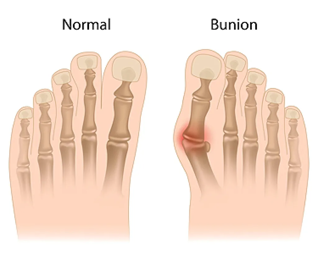 What Does a Bunion Look Like? Common Symptoms