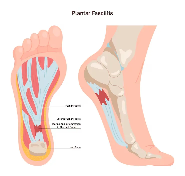 Heel Spur vs Plantar Fasciitis: Key Differences