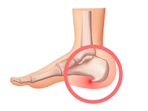 Heel Spur vs Plantar Fasciitis: Key Differences