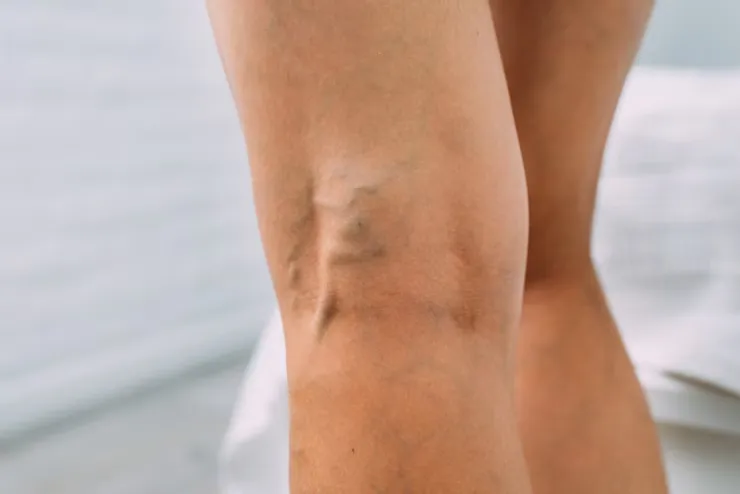 When to Worry About Varicose Veins: Doctor Tips