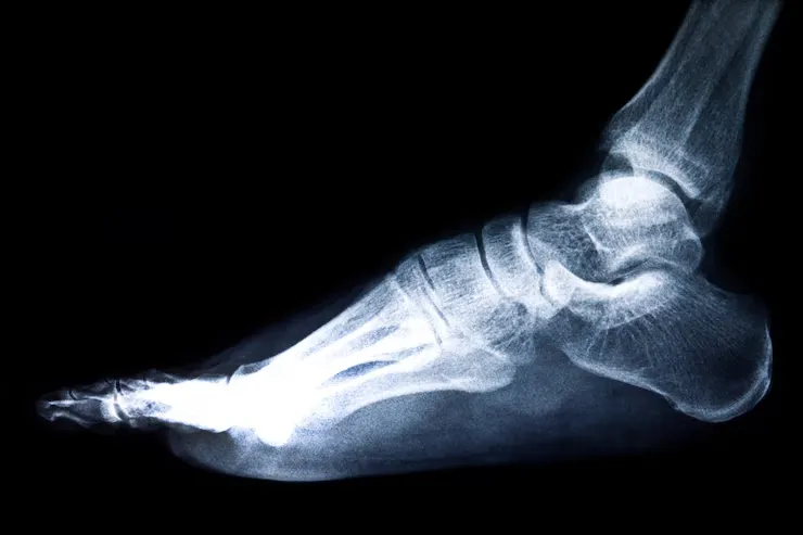 Sprain vs Fracture Foot: How to Tell the Difference