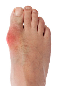 Gout in the foot